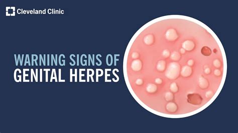 herpes in penus|Understanding Herpes on the Penis Head: Symptoms,。